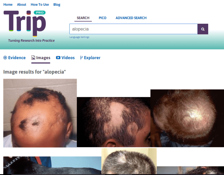 Alopecia