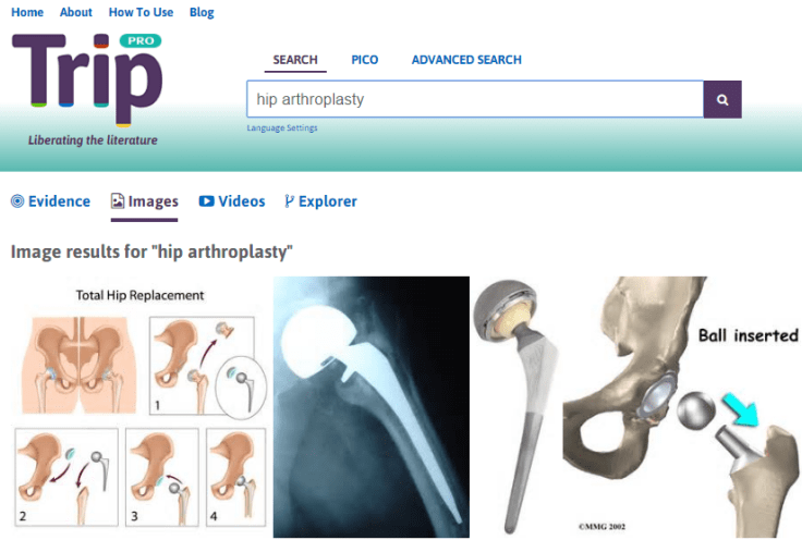 Hip arthoplasty